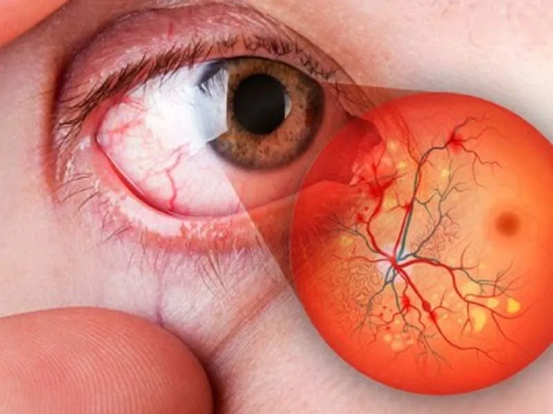 Corneal Diseases & Transplants in Indore