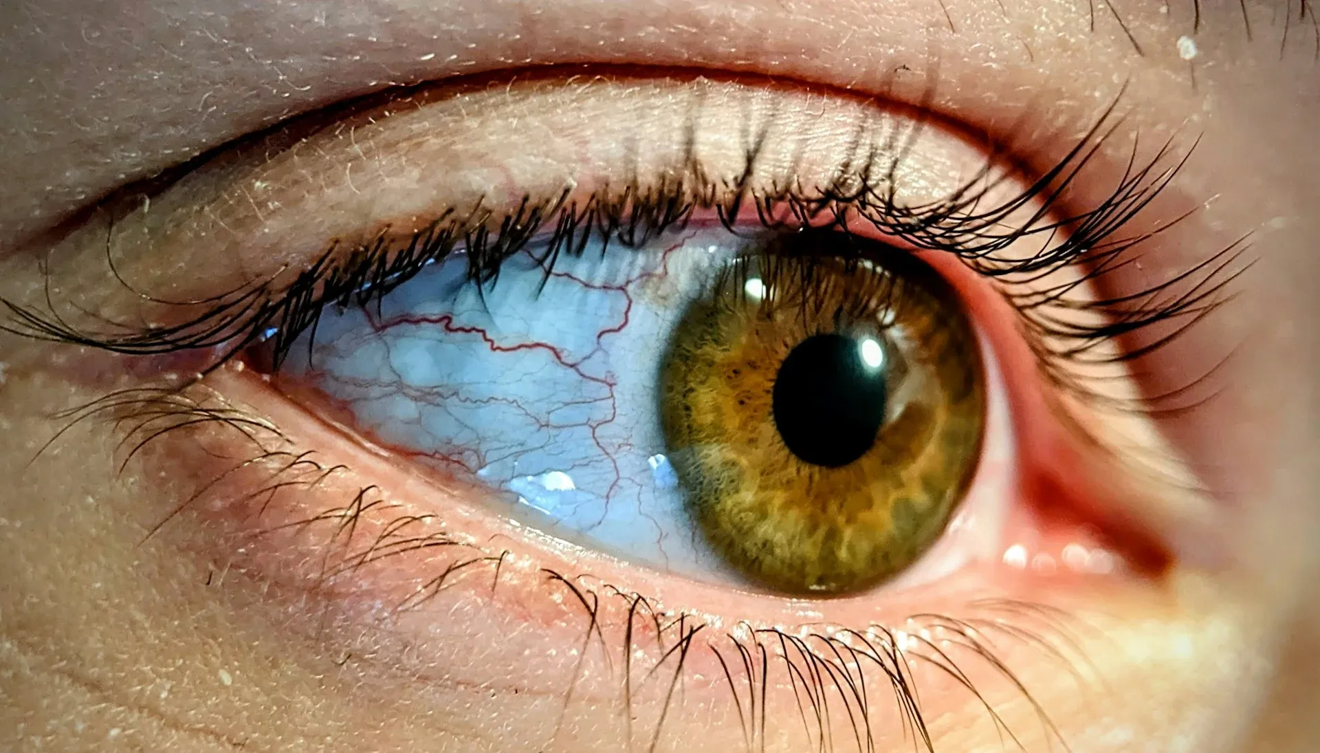 Diabetic Retinopathy