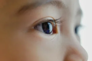 Squint Eye Treatment