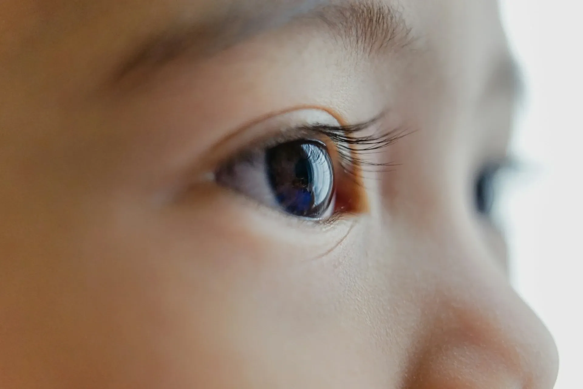 Squint Eye Treatment