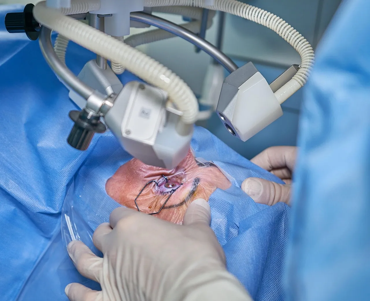 Cataract Surgery Signs